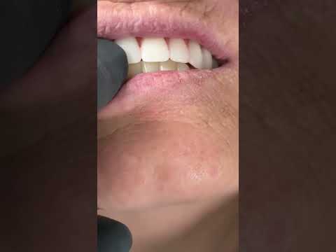 Before making full mouth implants zirconia!