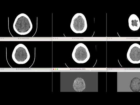 NeuroAlign CT: Revolutionizing CT Imaging with AI-Driven Precision
